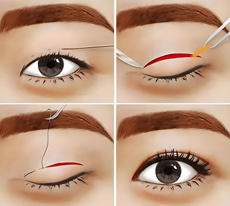 上海高冠云做双眼皮如何www.8682.cc