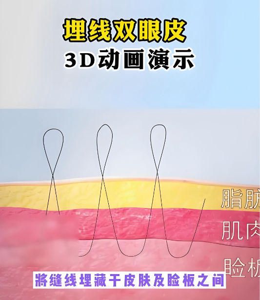 韩国ME双眼皮操作过程视频完整版来了，每一步都清清楚楚，看完再也不纠结了