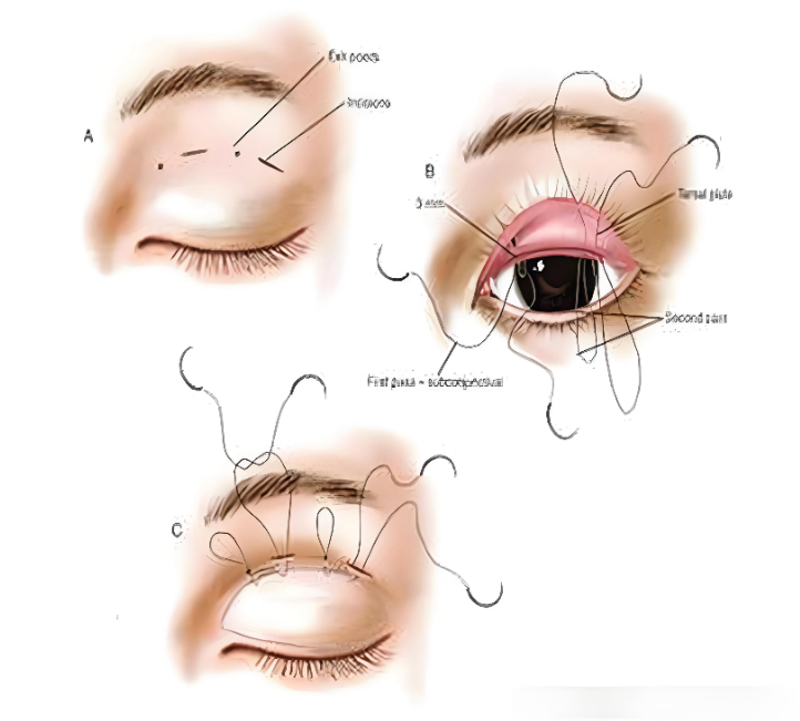 韩国ME双眼皮操作过程视频