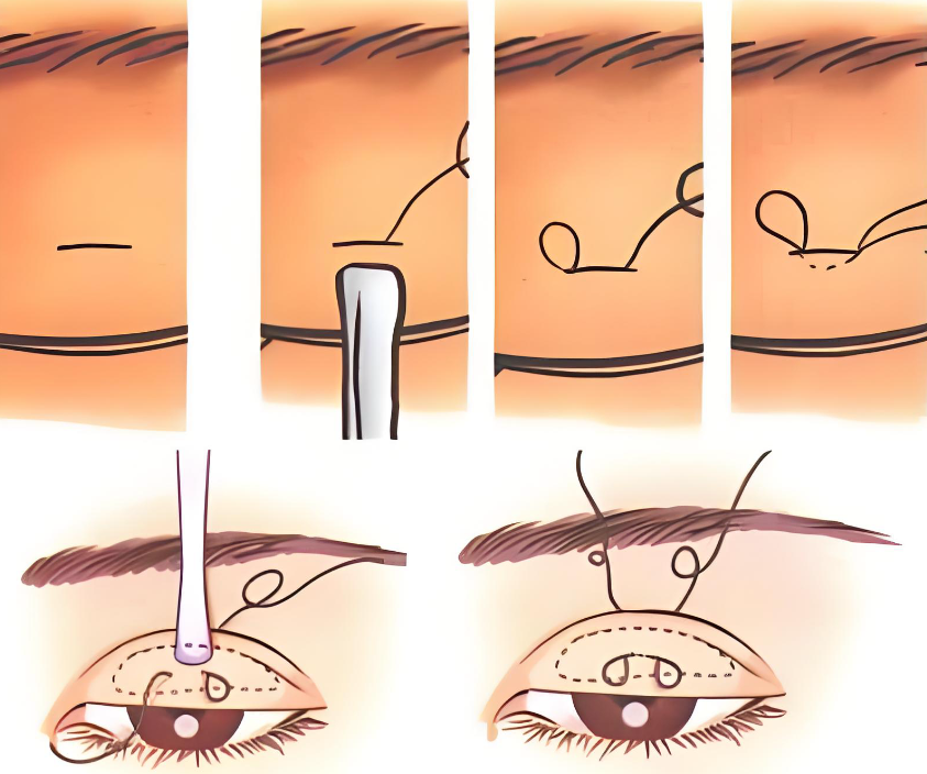 韩国ME双眼皮怎么样www.8682.cc