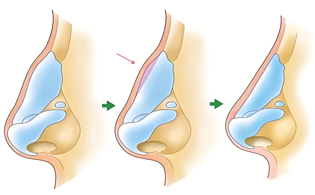 张辉赫本鼻怎么样www.8682.cc