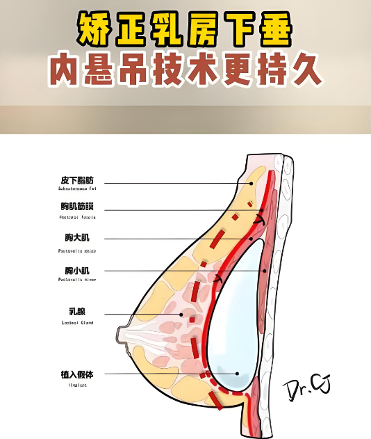 韩国做隆胸悬吊实例分享www.8682.cc