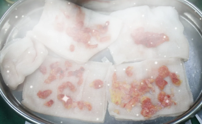 美雅枫生长因子取出:为什么能解决“越取越肿”的问题?