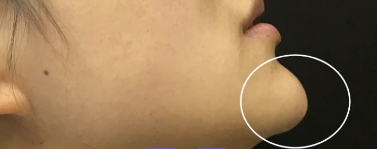 张立彬医生异物取出实例