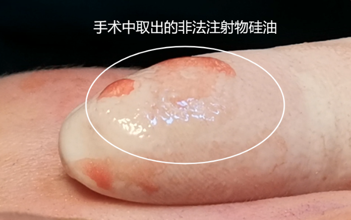 美雅枫异物取出就诊:提前知道这些,少走冤枉路