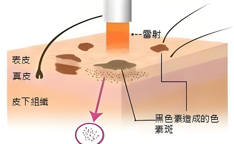 激光祛斑示意图
