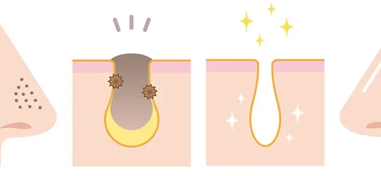 小气泡清洁项目