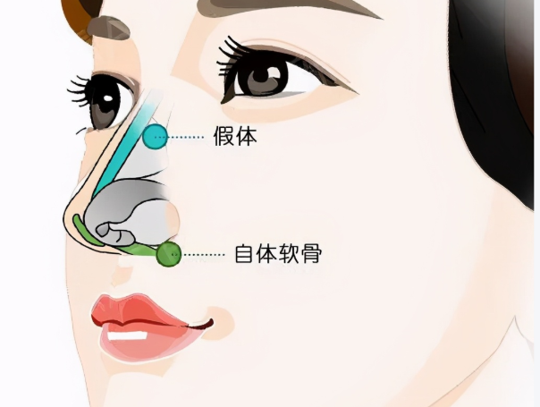 深圳张辉和王天国隆鼻哪个好？综合比较与选择建议