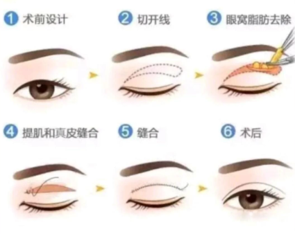 冯传波医生双眼皮手术的优势