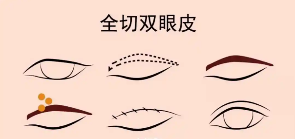 预约冯传波医生双眼皮手术的流程