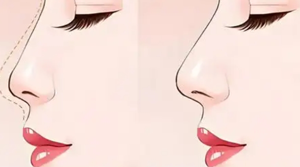 王天国做的桃花鼻子好看吗？特点是鼻梁高度不突兀、鼻尖微翘