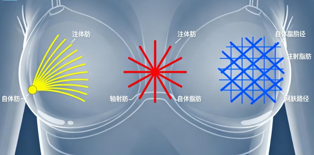 北京自体脂肪丰胸