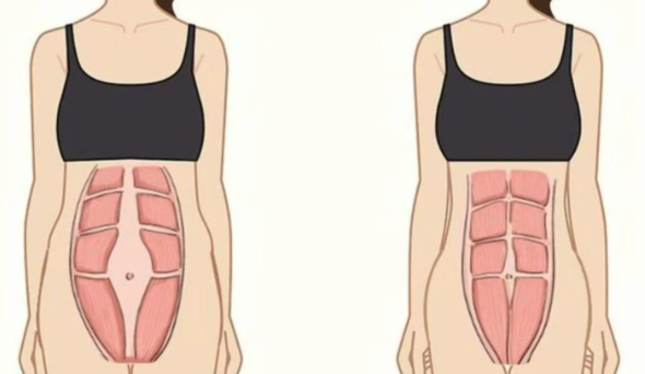 腹壁整形花了六万贵吗?从选择建议来看