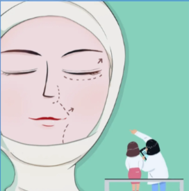 王召东筋膜固定手术