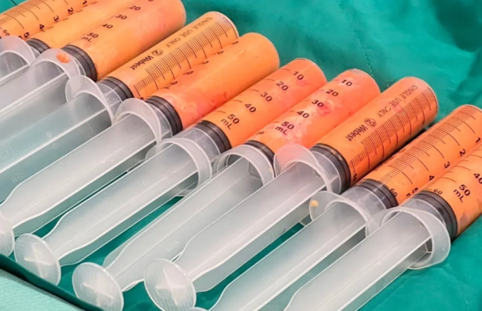 北京英煌自体脂肪隆胸术后变好周期要多久