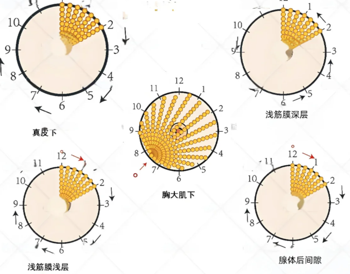 北京英煌自体脂肪隆胸前需要做哪些准备