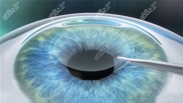 眼科医生李莹周一三五在茗视光出诊及手术