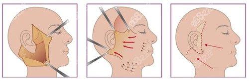 拉皮手术过程 拉皮手术过程