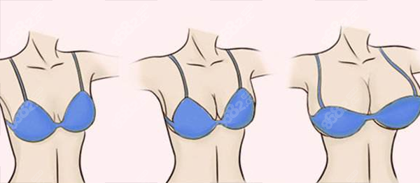 深圳市人民医院整形外科价格表：全切双眼皮6500元起，显微技术减术中出血