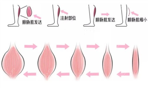 上海丽质卢九宁瘦小腿怎么样？20年经验多维直腿术自然