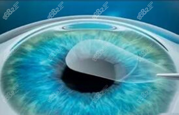 眼科医生李莹周一三五在茗视光出诊及手术，协和近视手术开拓者帮你get摘