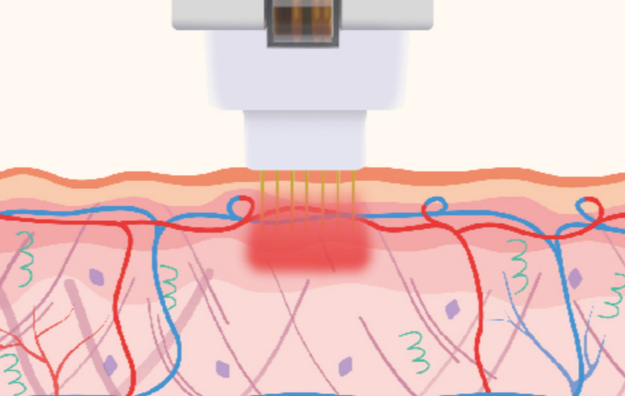韩国缩小毛孔的医美项目大盘点