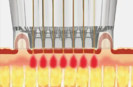 韩国缩小毛孔项目优缺点了解