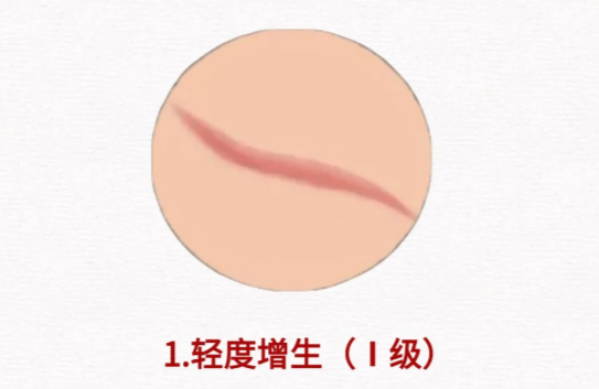 苏映军治疗疤痕疙瘩实例：分层修复技术+淡化成效实测，无滤镜反馈