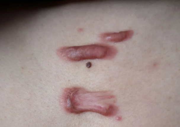 苏映军治疗疤痕疙瘩实例