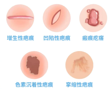 苏映军治疗疤痕疙瘩的好转管理：做好这4点，降低复发率