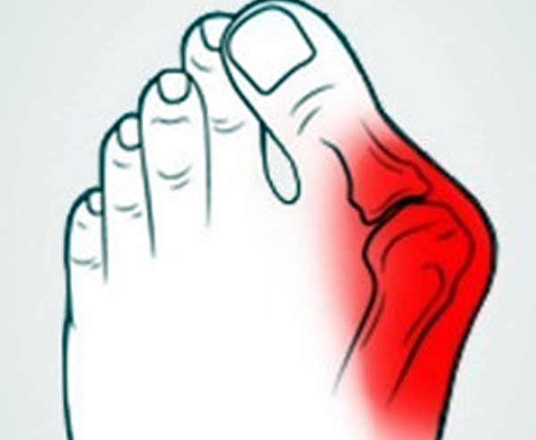 沈阳做大脚骨微创手术价格表：传统/微创、局麻/全麻等不同方式费用对比