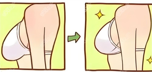 乳房下垂內(nèi)衣穿著對比