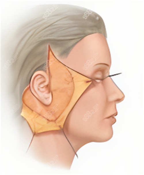 面部拉皮動畫演示圖