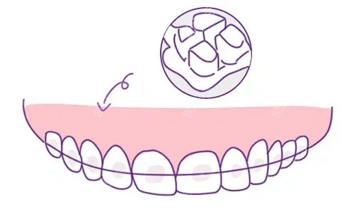 陶瓷托槽 陶瓷托槽