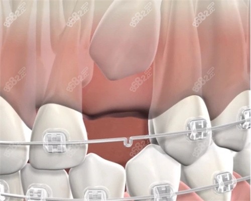 埋伏牙牵引 埋伏牙牵引