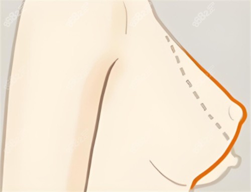 网友精选北京胸下垂矫正优质医生榜单！穆大力|祁佐良是头部医生技术好