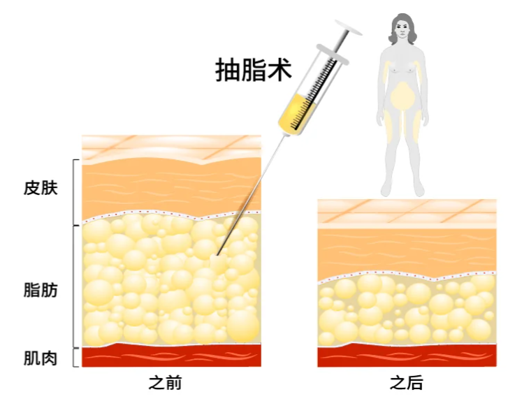 郑州吸脂医生杨柳价格