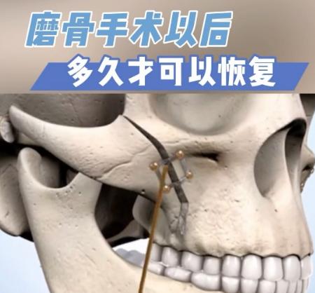 楊君毅磨骨一個(gè)部位多少錢？28000-35000元是多數(shù)人的實(shí)際付費(fèi)范圍