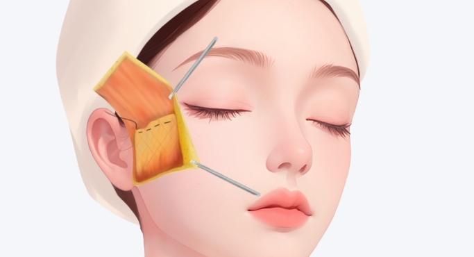 成都友誼整形醫(yī)院筋膜懸吊手術(shù)價格表：8000元起真實價，單/全面部價都有