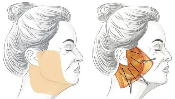 成都友谊整形医院筋膜提升