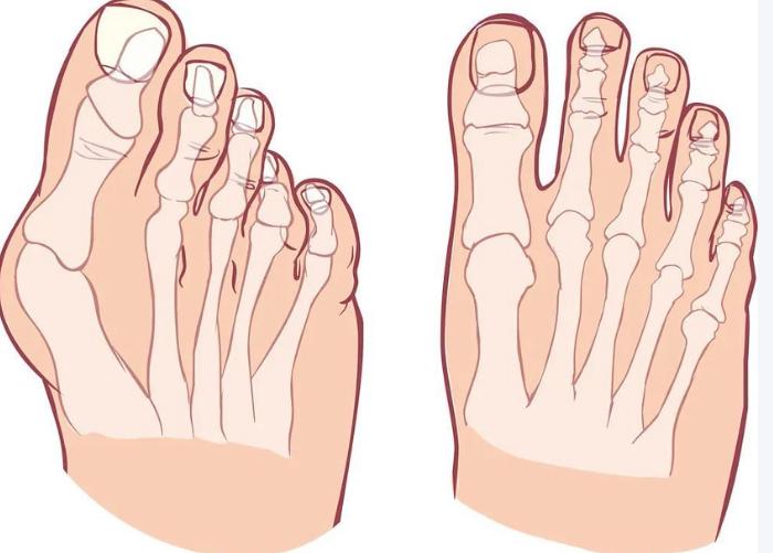 拇指外翻收費(fèi)