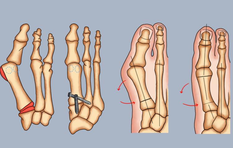 圣嘉新拇外翻预约挂号流程