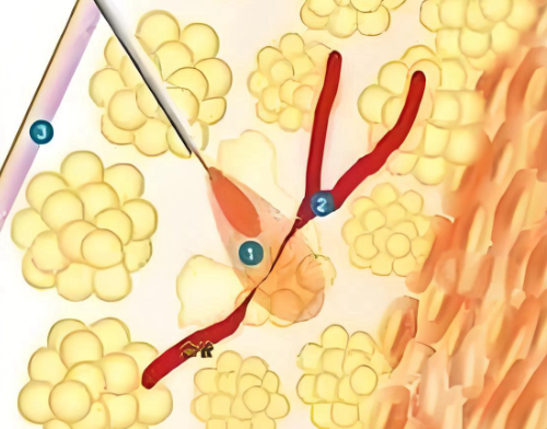 維密金雕手術(shù)的風(fēng)險(xiǎn)