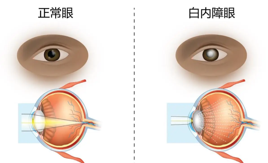 佛山華廈眼科醫(yī)院做白內(nèi)障手術(shù)可以嗎？設(shè)備不錯(cuò)