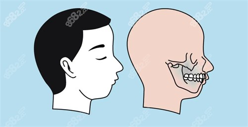 凸嘴的圖片 凸嘴的圖片