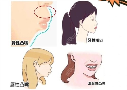 不同類型的凸嘴 不同類型的凸嘴