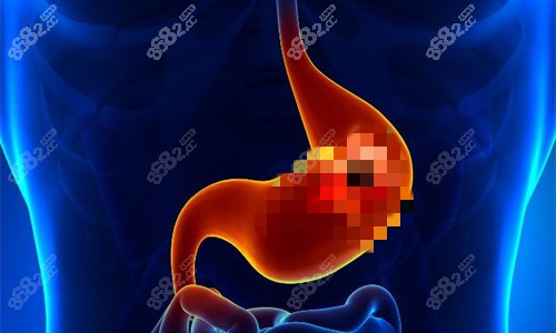 胃部病變展示圖 胃部病變展示圖