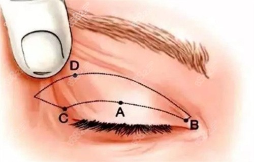 全切雙眼皮術(shù)前設(shè)計