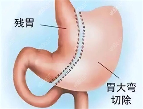 袖狀胃切除手術改善展示圖 袖狀胃切除手術改善展示圖