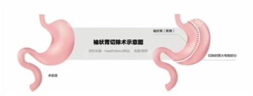 袖狀胃切除手術示意圖 袖狀胃切除手術示意圖